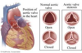 Aortic Stenosis - Lily's Heart Warriors